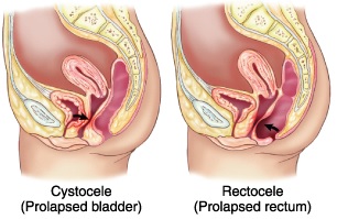 Uterine Prolapse (prolapsed uterus) – Pelvic organ prolapse