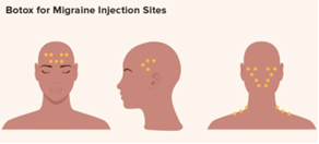 Botox injection sites.