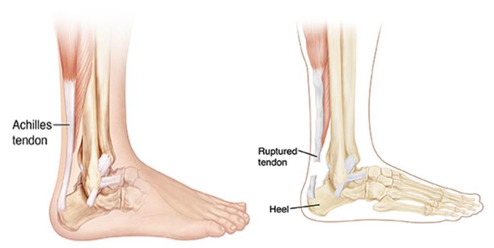 Image of a ruptured tendon