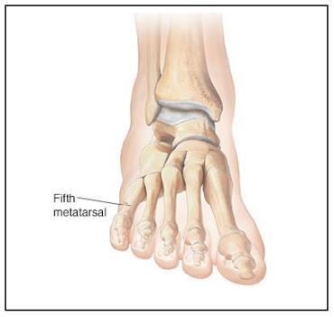 Image of base of 5th metatarsal fracture